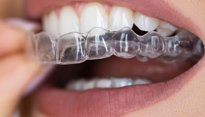 Orthodontie gouttières transparentes Casablanca